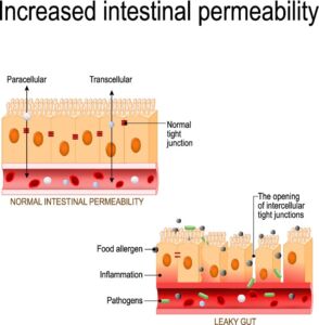Leaky Gut Syndrome